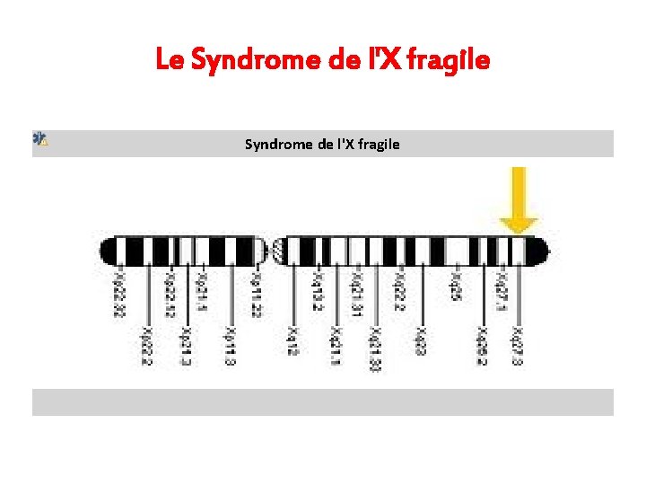 Le Syndrome de l'X fragile Localisation du gène FMR 1. 309550 