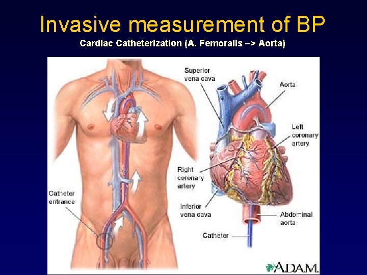 Invasive measurement of BP Cardiac Catheterization (A. Femoralis –> Aorta) 