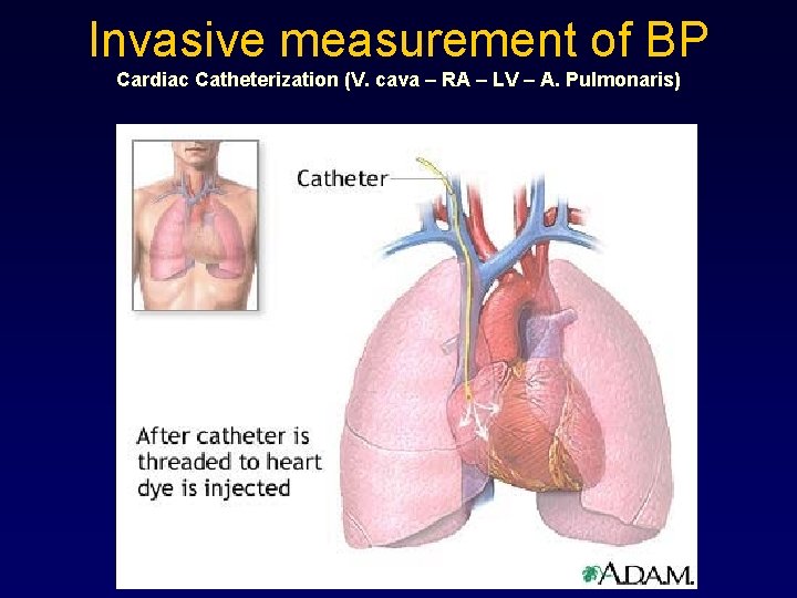 Invasive measurement of BP Cardiac Catheterization (V. cava – RA – LV – A.