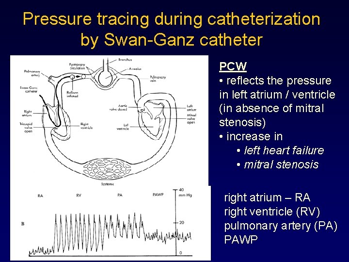 Pressure tracing during catheterization by Swan-Ganz catheter PCW • reflects the pressure in left