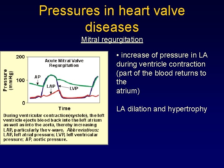 Pressures in heart valve diseases Mitral regurgitation • increase of pressure in LA during