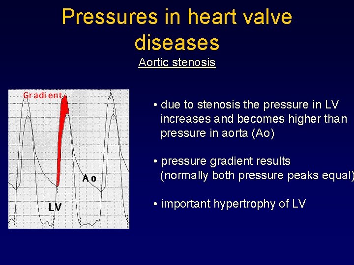 Pressures in heart valve diseases Aortic stenosis • due to stenosis the pressure in