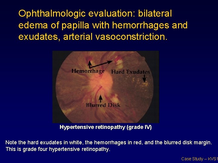 Ophthalmologic evaluation: bilateral edema of papilla with hemorrhages and exudates, arterial vasoconstriction. Hypertensive retinopathy