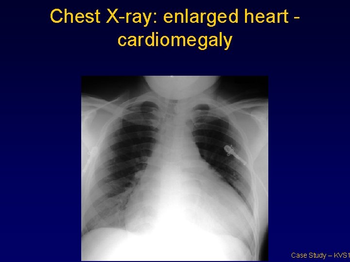 Chest X-ray: enlarged heart - cardiomegaly Case Study – KVS 1 