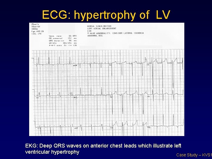 ECG: hypertrophy of LV EKG: Deep QRS waves on anterior chest leads which illustrate