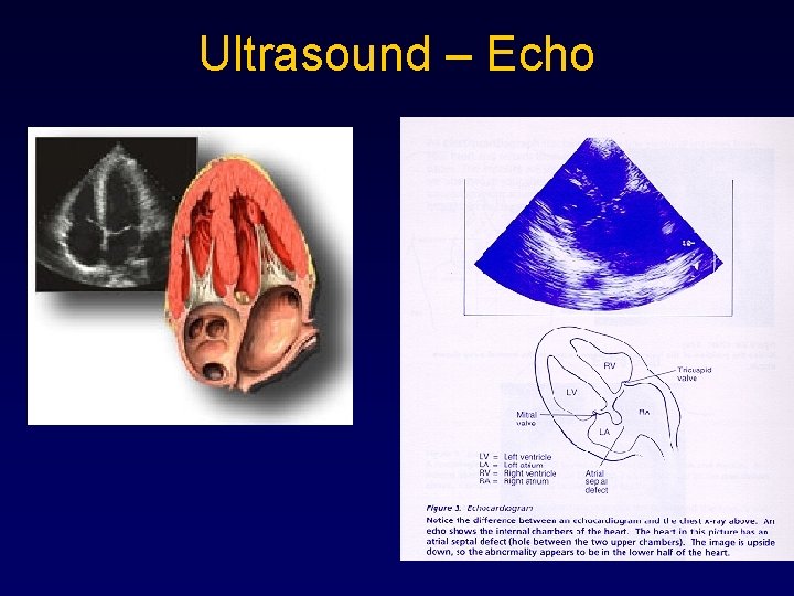 Ultrasound – Echo 