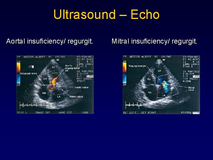 Ultrasound – Echo Aortal insuficiency/ regurgit. Mitral insuficiency/ regurgit. 
