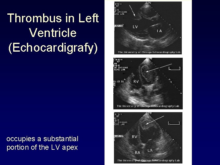 Thrombus in Left Ventricle (Echocardigrafy) occupies a substantial portion of the LV apex 