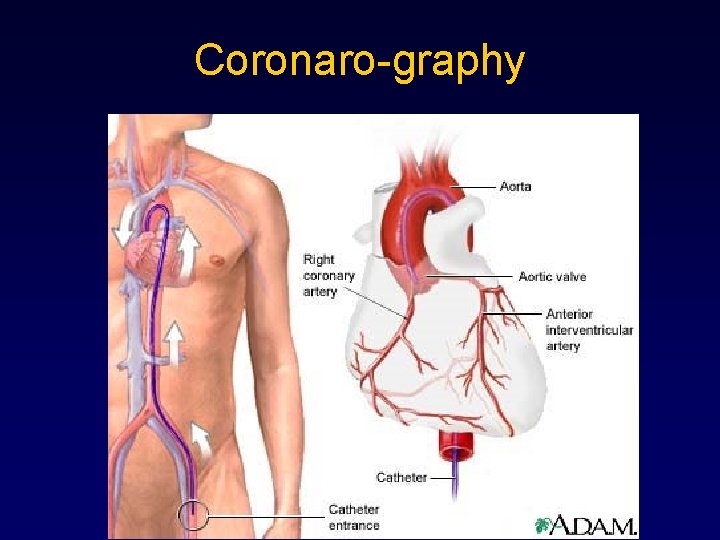 Coronaro-graphy 