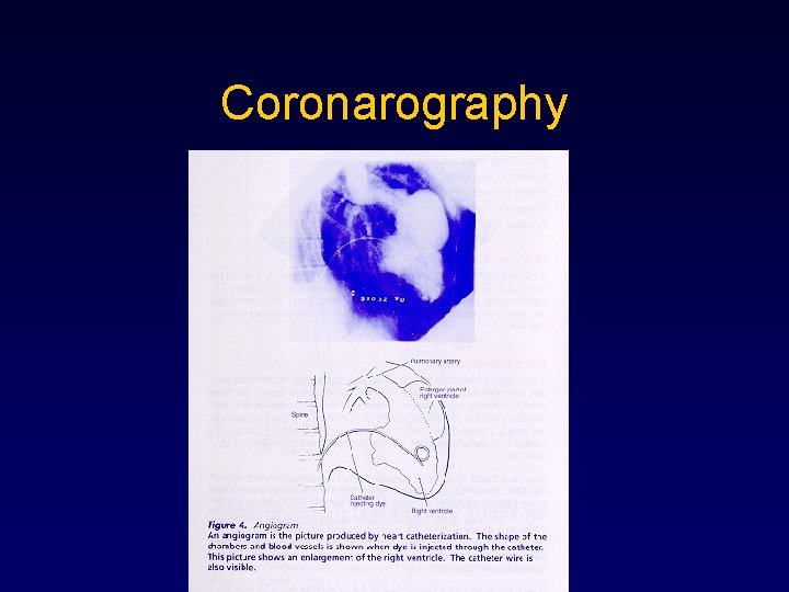 Coronarography 