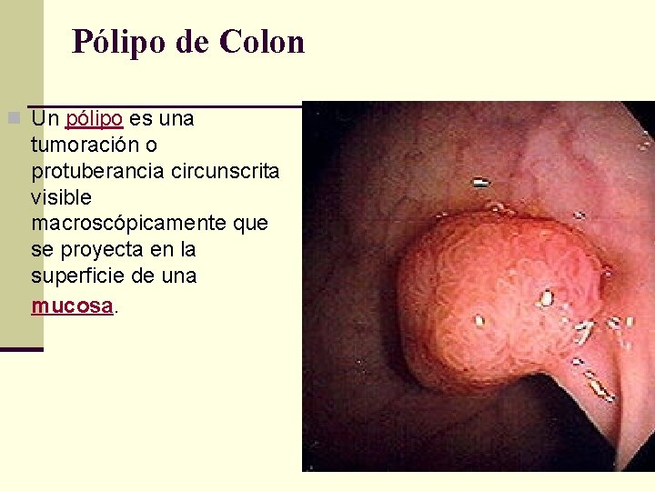 Pólipo de Colon n Un pólipo es una tumoración o protuberancia circunscrita visible macroscópicamente