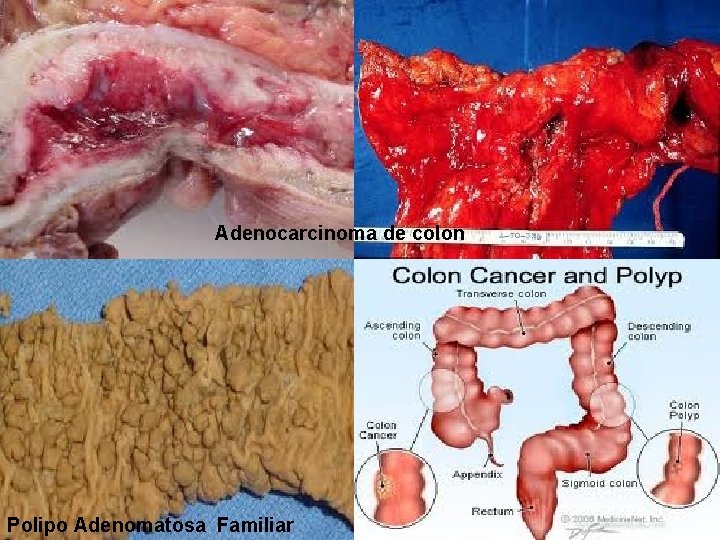 Adenocarcinoma de colon Polipo Adenomatosa Familiar 