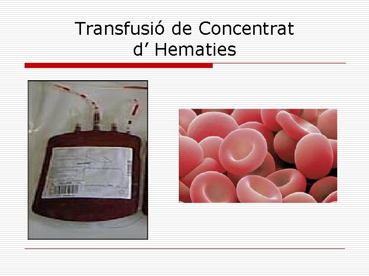 Transfusió de Concentrat d’ Hematies 