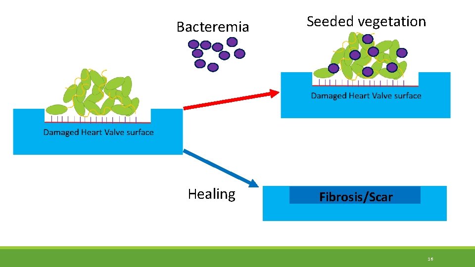 Bacteremia Healing Seeded vegetation Fibrosis/Scar 16 Bacteremia Healing Seeded vegetation Fibrosis/Scar 16