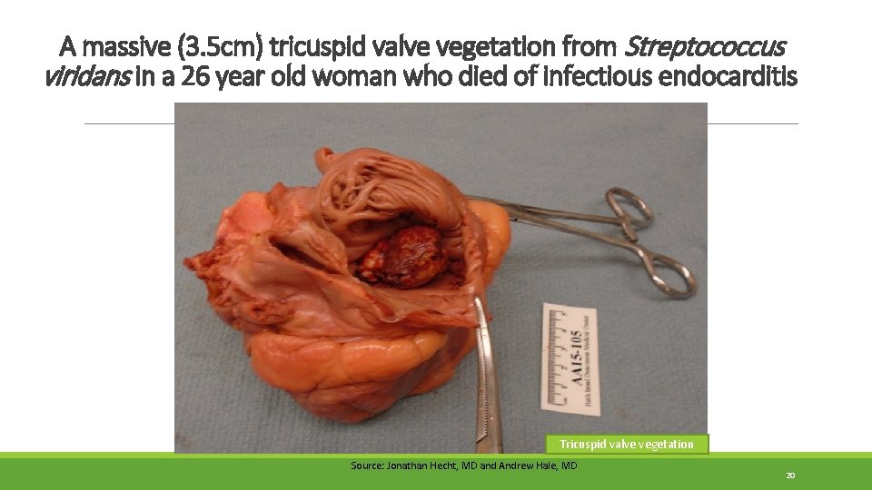 A massive (3. 5 cm) tricuspid valve vegetation from Streptococcus viridans in a 26 A massive (3. 5 cm) tricuspid valve vegetation from Streptococcus viridans in a 26