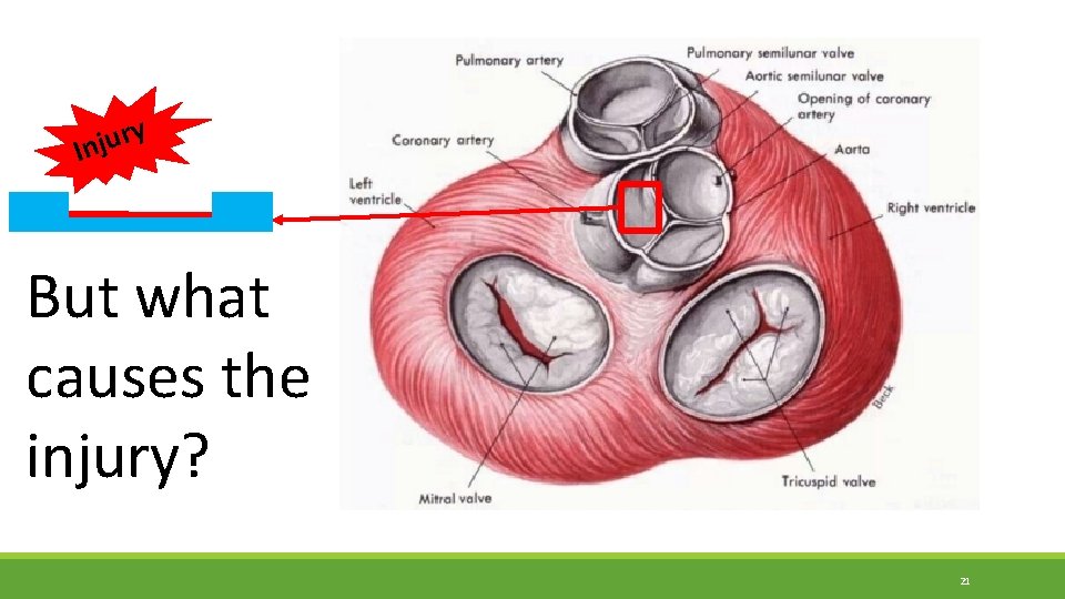 y r u j In But what causes the injury? 21 y r u j In But what causes the injury? 21