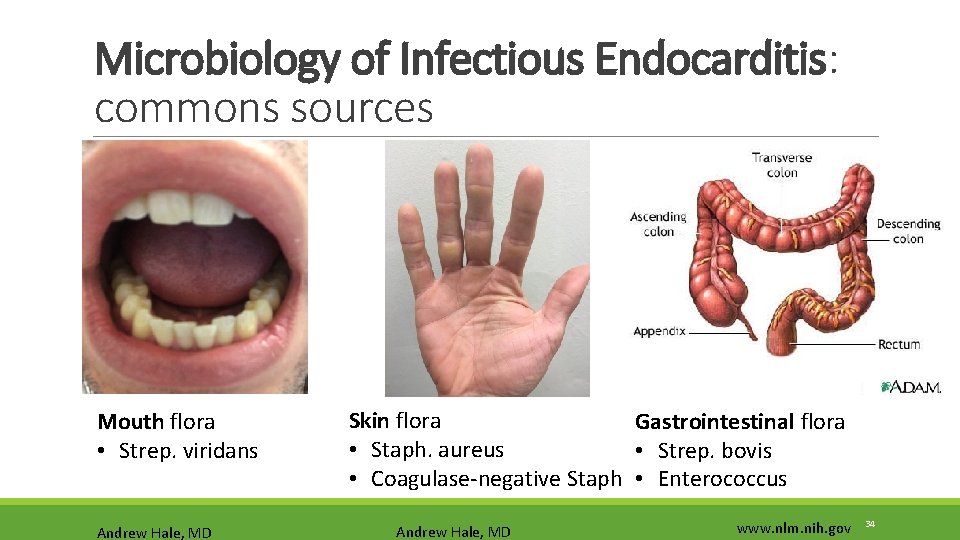 Microbiology of Infectious Endocarditis: commons sources Mouth flora • Strep. viridans Andrew Hale, MD Microbiology of Infectious Endocarditis: commons sources Mouth flora • Strep. viridans Andrew Hale, MD