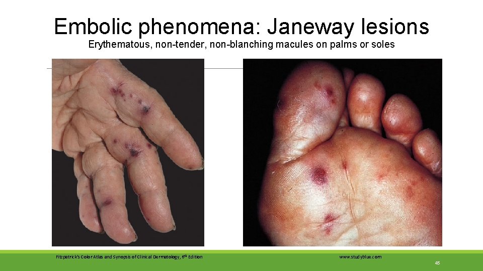 Embolic phenomena: Janeway lesions Erythematous, non-tender, non-blanching macules on palms or soles Fitzpatrick’s Color Embolic phenomena: Janeway lesions Erythematous, non-tender, non-blanching macules on palms or soles Fitzpatrick’s Color