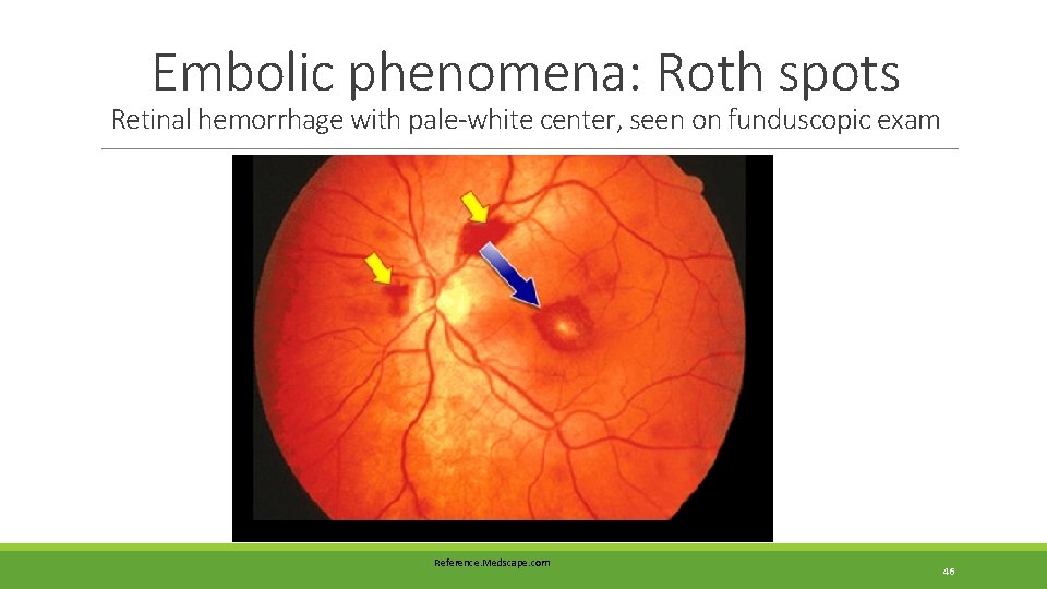 Embolic phenomena: Roth spots Retinal hemorrhage with pale-white center, seen on funduscopic exam Reference. Embolic phenomena: Roth spots Retinal hemorrhage with pale-white center, seen on funduscopic exam Reference.
