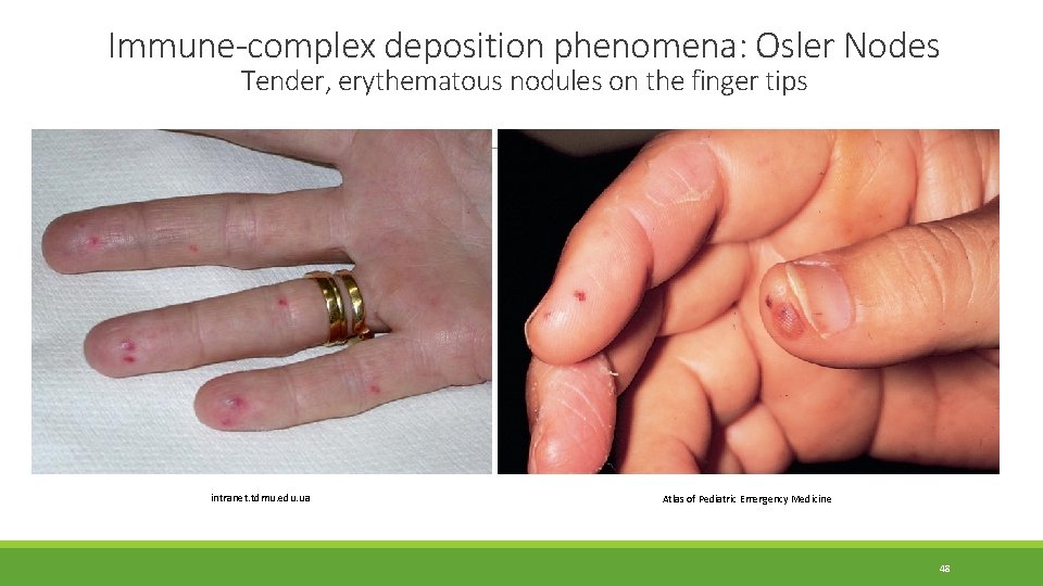 Immune-complex deposition phenomena: Osler Nodes Tender, erythematous nodules on the finger tips intranet. tdmu. Immune-complex deposition phenomena: Osler Nodes Tender, erythematous nodules on the finger tips intranet. tdmu.