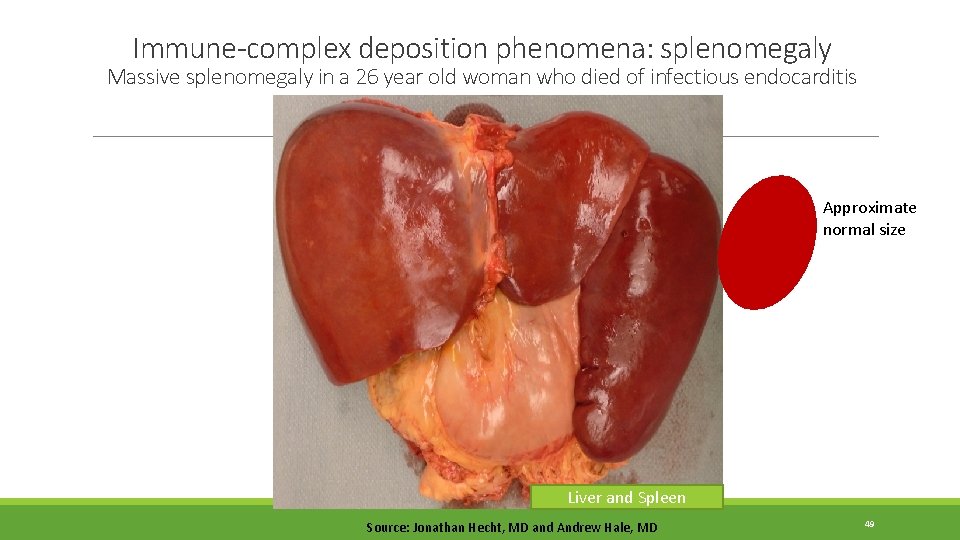 Immune-complex deposition phenomena: splenomegaly Massive splenomegaly in a 26 year old woman who died Immune-complex deposition phenomena: splenomegaly Massive splenomegaly in a 26 year old woman who died