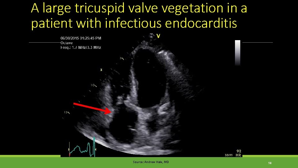 A large tricuspid valve vegetation in a patient with infectious endocarditis Source: Andrew Hale, A large tricuspid valve vegetation in a patient with infectious endocarditis Source: Andrew Hale,