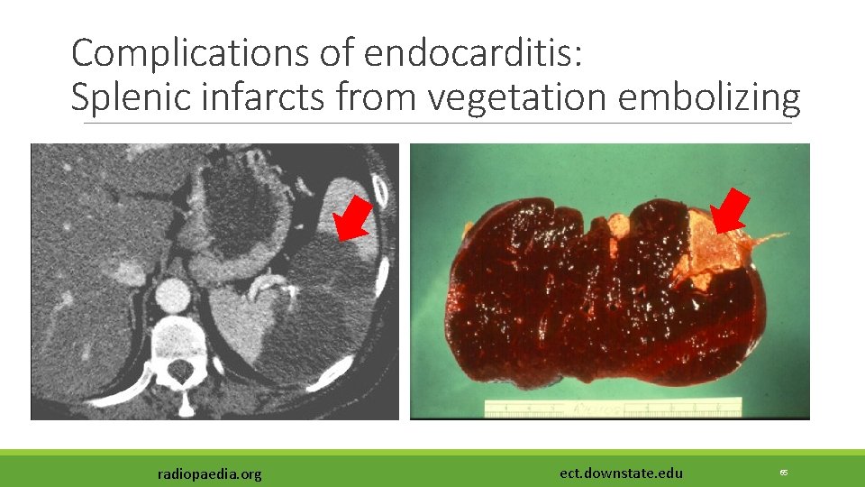 Complications of endocarditis: Splenic infarcts from vegetation embolizing radiopaedia. org ect. downstate. edu 65 Complications of endocarditis: Splenic infarcts from vegetation embolizing radiopaedia. org ect. downstate. edu 65