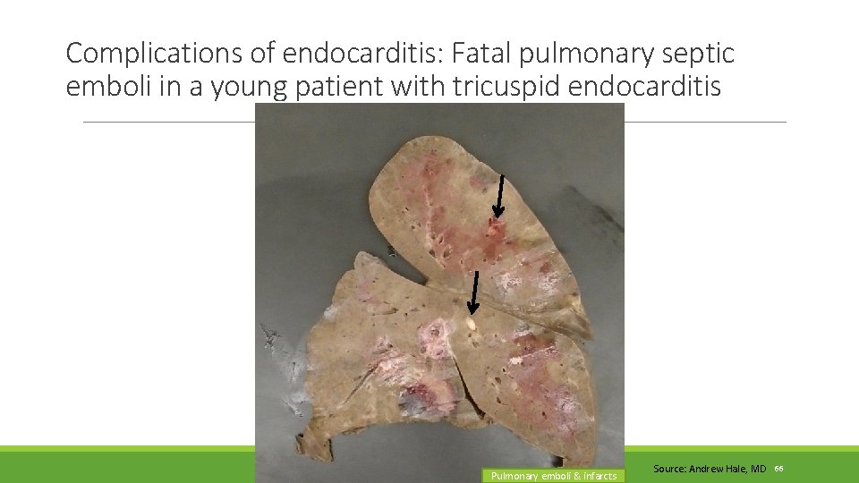 Complications of endocarditis: Fatal pulmonary septic emboli in a young patient with tricuspid endocarditis Complications of endocarditis: Fatal pulmonary septic emboli in a young patient with tricuspid endocarditis