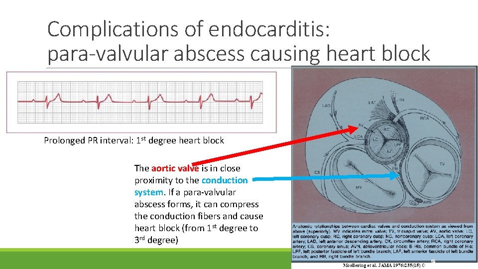 Complications of endocarditis: para-valvular abscess causing heart block Prolonged PR interval: 1 st degree Complications of endocarditis: para-valvular abscess causing heart block Prolonged PR interval: 1 st degree