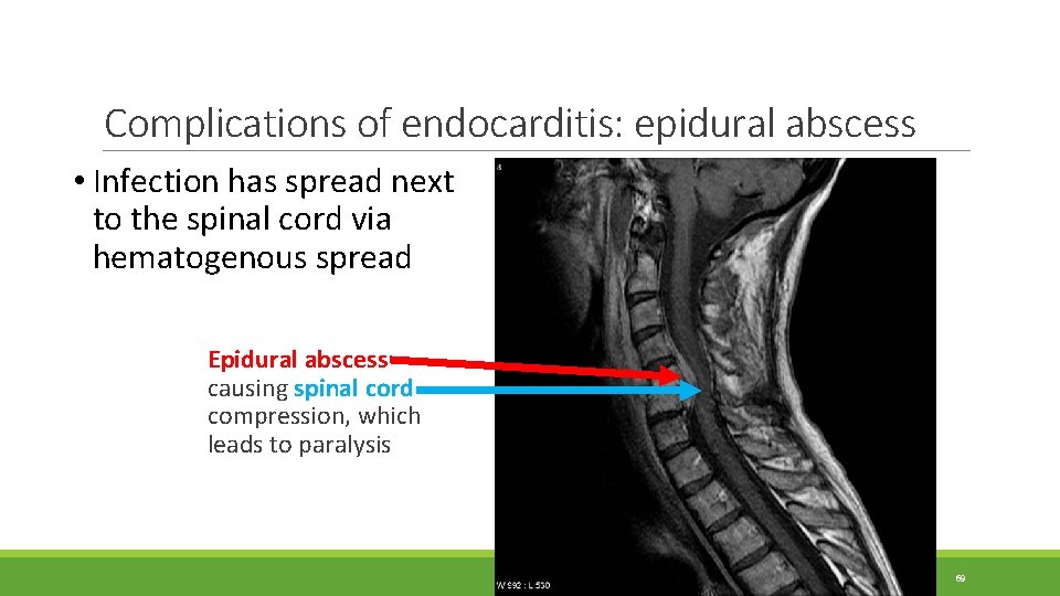 Complications of endocarditis: epidural abscess • Infection has spread next to the spinal cord Complications of endocarditis: epidural abscess • Infection has spread next to the spinal cord