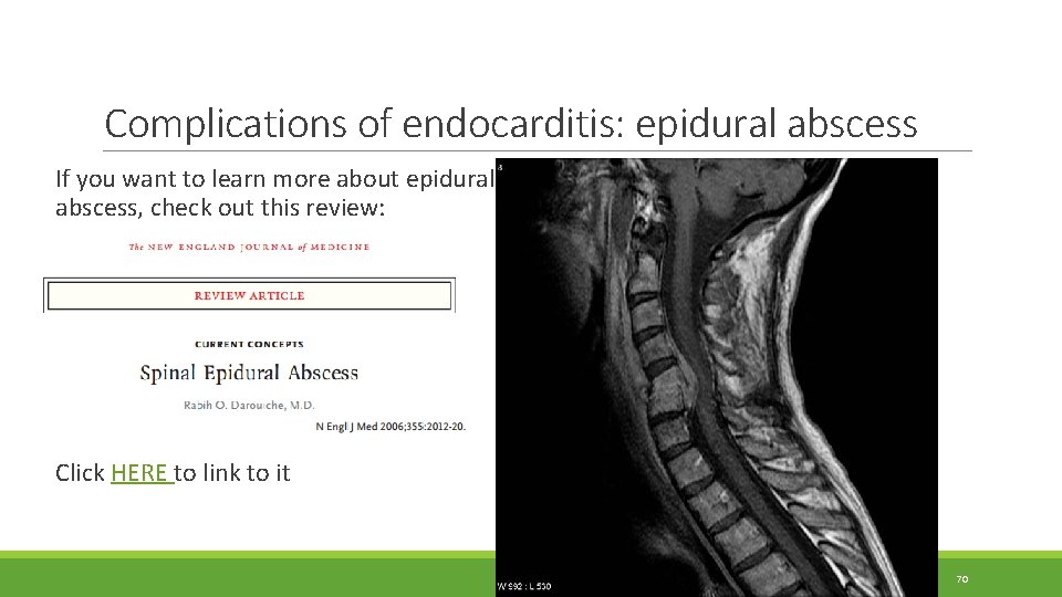 Complications of endocarditis: epidural abscess If you want to learn more about epidural abscess, Complications of endocarditis: epidural abscess If you want to learn more about epidural abscess,