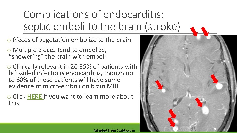 Complications of endocarditis: septic emboli to the brain (stroke) o Pieces of vegetation embolize Complications of endocarditis: septic emboli to the brain (stroke) o Pieces of vegetation embolize