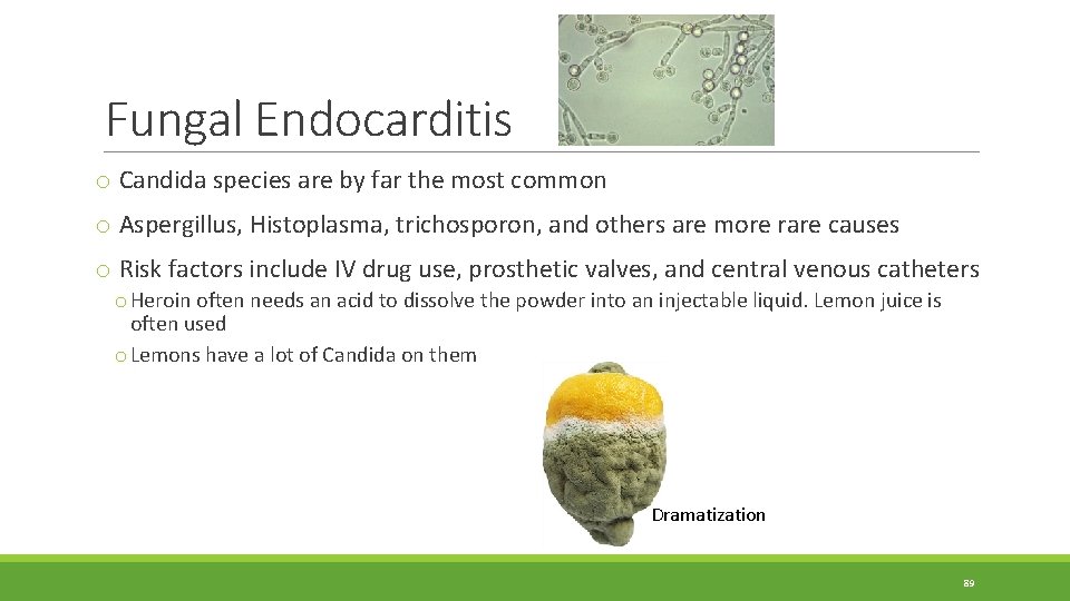 Fungal Endocarditis o Candida species are by far the most common o Aspergillus, Histoplasma, Fungal Endocarditis o Candida species are by far the most common o Aspergillus, Histoplasma,