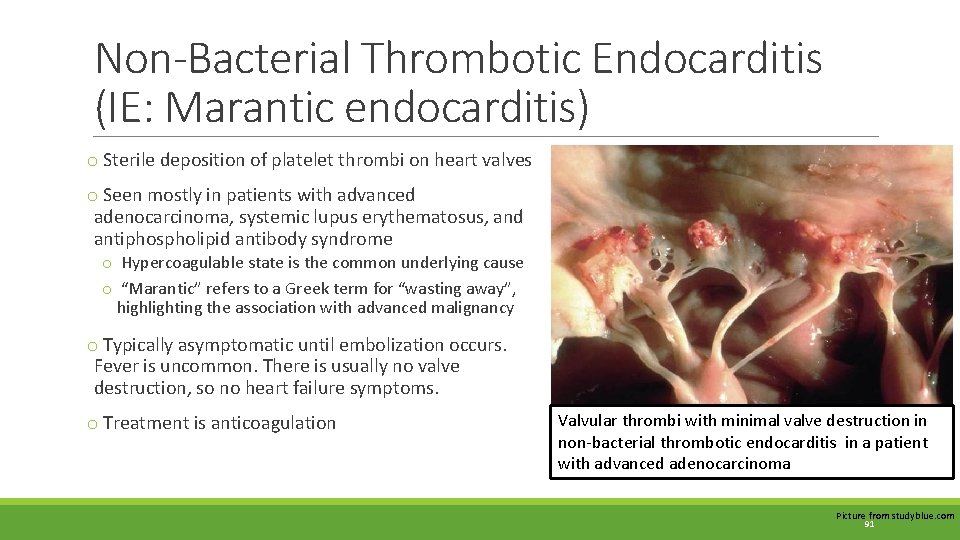 Non-Bacterial Thrombotic Endocarditis (IE: Marantic endocarditis) o Sterile deposition of platelet thrombi on heart Non-Bacterial Thrombotic Endocarditis (IE: Marantic endocarditis) o Sterile deposition of platelet thrombi on heart