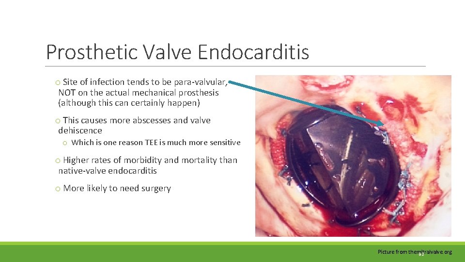 Prosthetic Valve Endocarditis o Site of infection tends to be para-valvular, NOT on the Prosthetic Valve Endocarditis o Site of infection tends to be para-valvular, NOT on the