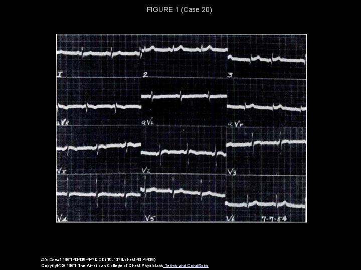 FIGURE 1 (Case 20) Dis Chest 1961 40439 -447 DOI: (10. 1378/chest. 40. 4.