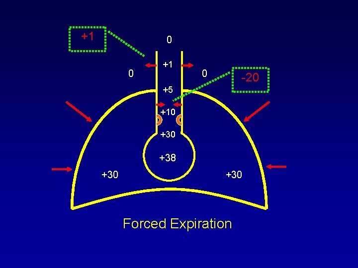 +1 0 0 +1 0 -20 +5 +10 +38 +30 Forced Expiration +1 0 0 +1 0 -20 +5 +10 +38 +30 Forced Expiration