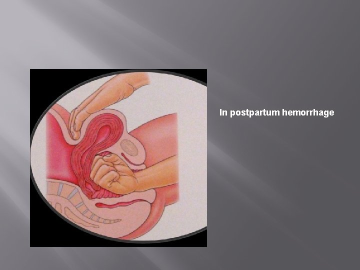 In postpartum hemorrhage 