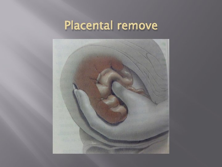 Placental remove 