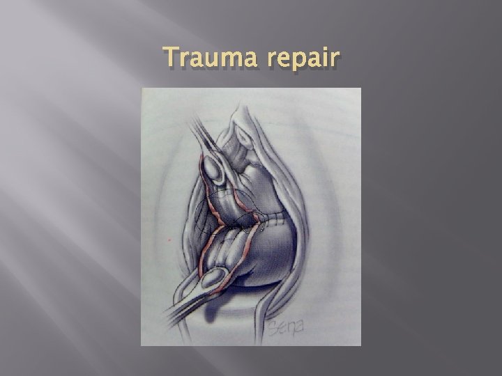Trauma repair 
