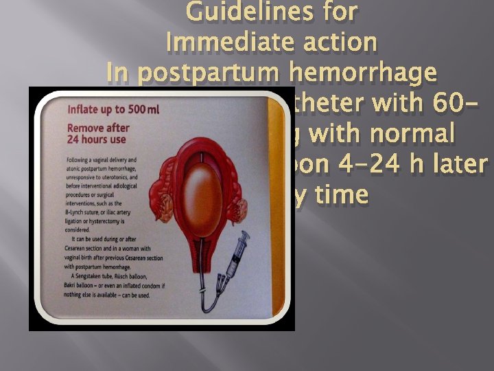 Guidelines for Immediate action In postpartum hemorrhage 3 -4 no: 16 Folly catheter with