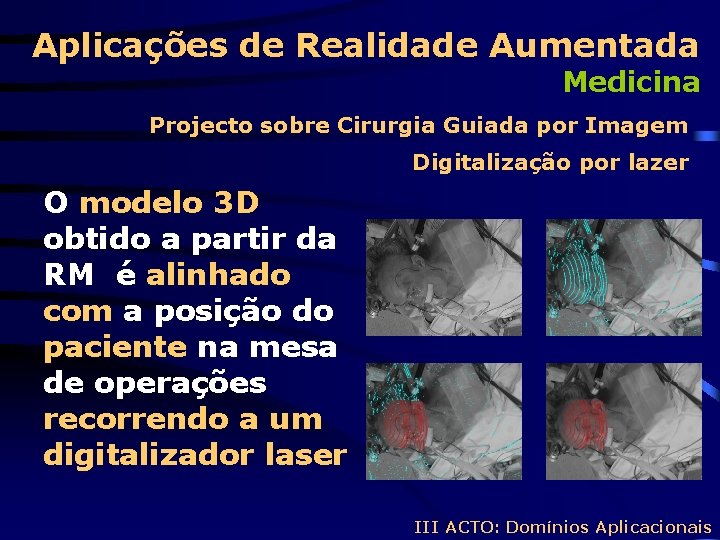Aplicações de Realidade Aumentada Medicina Projecto sobre Cirurgia Guiada por Imagem Digitalização por lazer