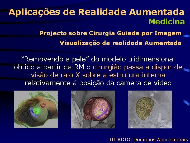 Aplicações de Realidade Aumentada Medicina Projecto sobre Cirurgia Guiada por Imagem Visualização da realidade