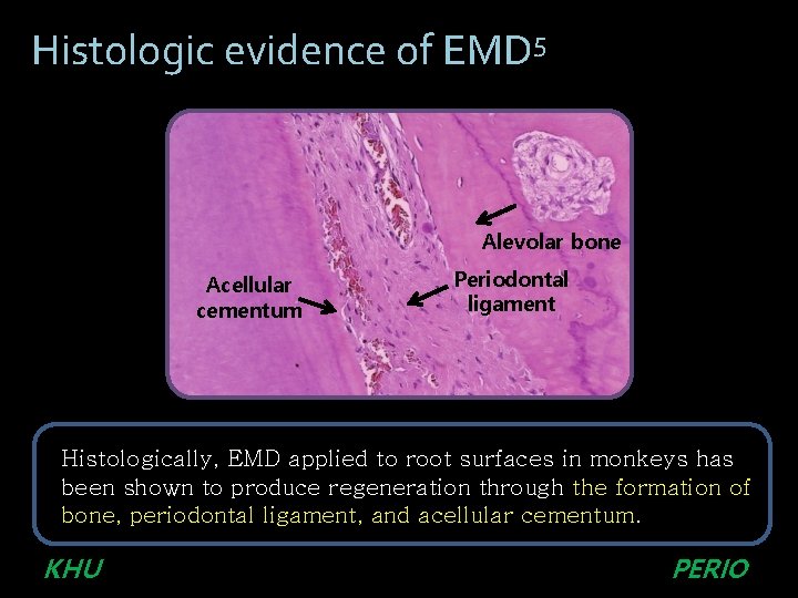 Histologic evidence of EMD 5 Alevolar bone Acellular cementum Periodontal ligament Histologically, EMD applied Histologic evidence of EMD 5 Alevolar bone Acellular cementum Periodontal ligament Histologically, EMD applied