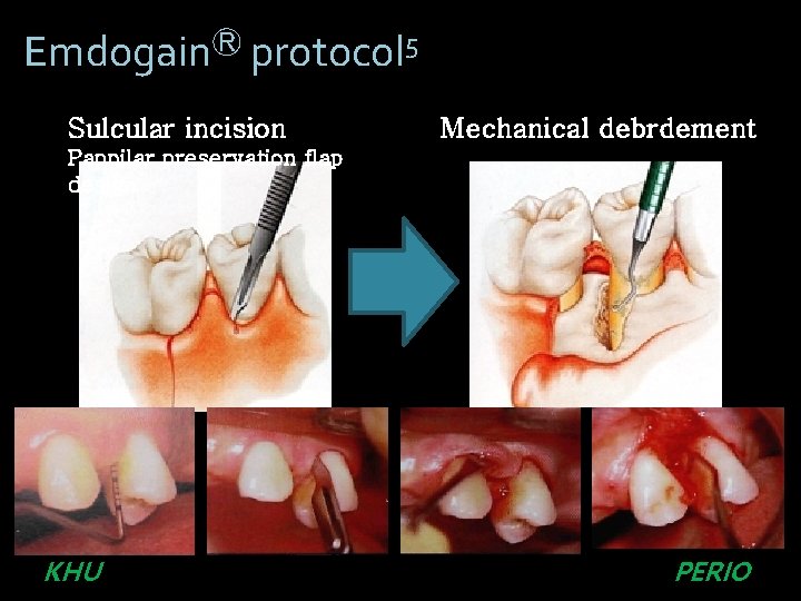 EmdogainⓇ protocol 5 Sulcular incision Mechanical debrdement Pappilar preservation flap design 4 KHU PERIO