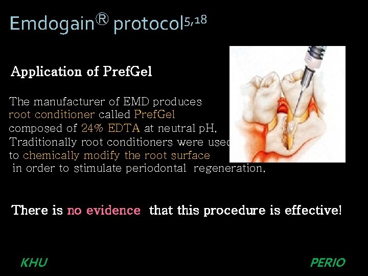 EmdogainⓇ protocol 5, 18 Application of Pref. Gel The manufacturer of EMD produces root EmdogainⓇ protocol 5, 18 Application of Pref. Gel The manufacturer of EMD produces root