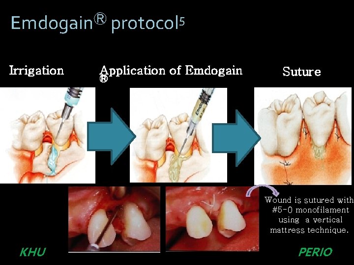 EmdogainⓇ protocol 5 Irrigation Application of Emdogain Ⓡ Suture 2 Wound is sutured with