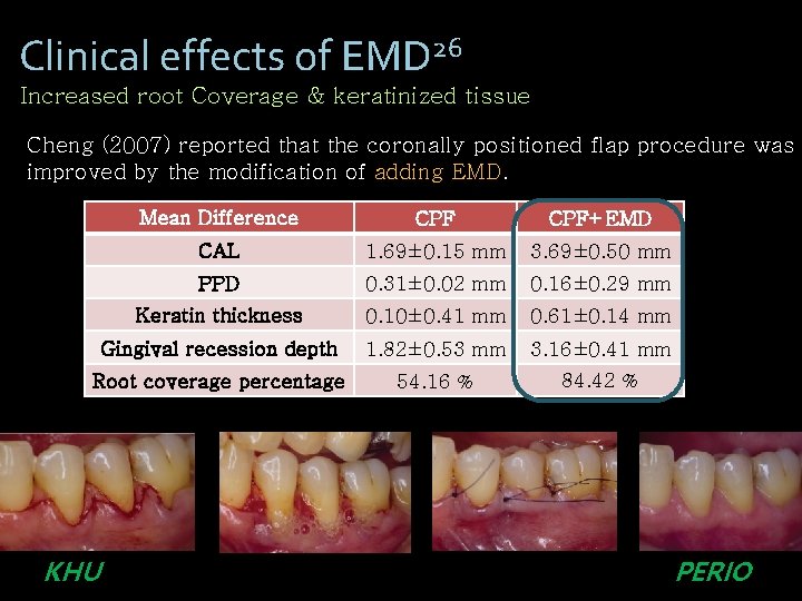Clinical effects of EMD 26 Increased root Coverage & keratinized tissue Cheng (2007) reported