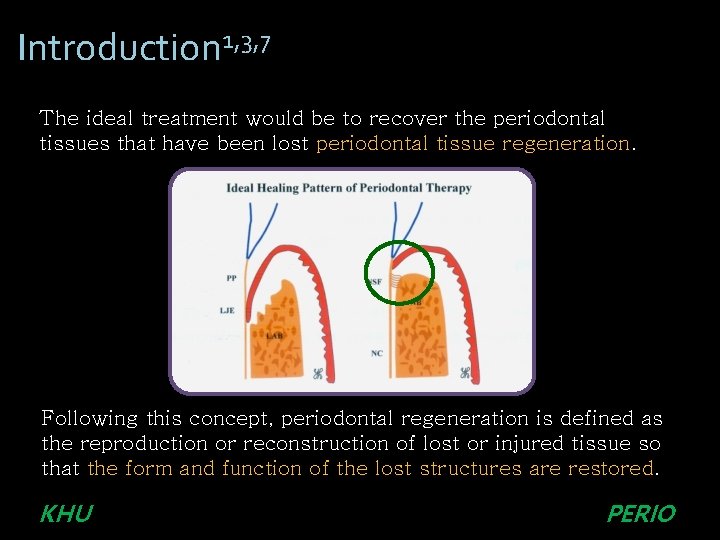 Introduction 1, 3, 7 The ideal treatment would be to recover the periodontal tissues