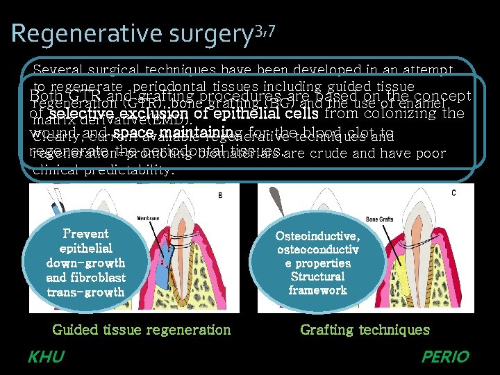 Regenerative surgery 3, 7 Several surgical techniques have been developed in an attempt to